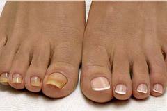 3 народни трика, с които да премахнете завинаги досадните гъбички на краката!