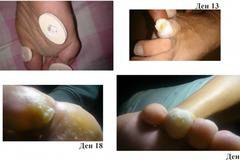 Как се маха кокоши трън с народни рецепти? Отговаряме как се маха кокоши трън!