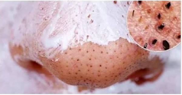 Черните Точки и Пъпките ще Изчезнат бързо с тези 3 Домашно Приготвени Рецепти