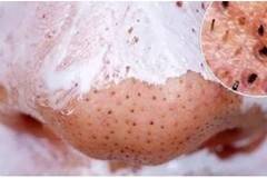 Черните Точки и Пъпките ще Изчезнат бързо с тези 3 Домашно Приготвени Рецепти