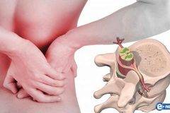 Наш народен лечител разби на пух и прах бялата мафия! Вижте как да се излекувате от дисковата херния за дни!