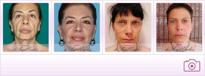 Фейслифт – Пластична хирургия д-р Ангел Енчев