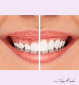 Gummy Smile Reduction (корекция на венечна усмивка) – Клиника за пластична хирургия Симетрия