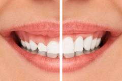 Gummy Smile Reduction (корекция на венечна усмивка) - Клиника за пластична хирургия Симетрия