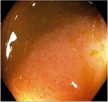 Резултати след контролна колоноскопия на болен с дългогодишен улцерозен колит