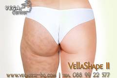 Премахване на целулит и стягане на кожата с VelaShape II