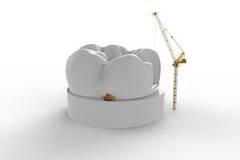 Колко струват зъбните импланти?