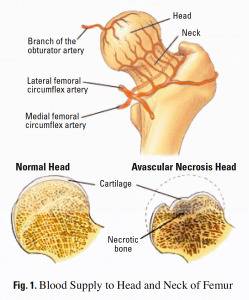 Асептична некроза на бедрената глава (остеохондропатии)