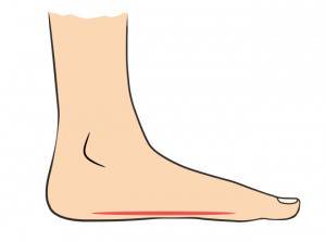 Упражнения при плоскостъпие и спаднал свод