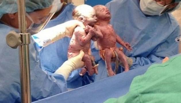 Тези близначки трогнаха света когато се родиха хванати за ръце, но само ги вижте 4 години по-късно (снимки)