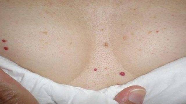 Ако имате подобни червени бенки по тялото задължително трябва да знаете ТОВА!