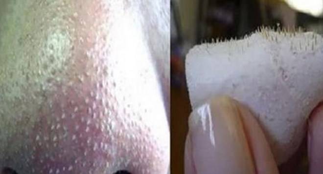 Как да махнем черните точки завинаги? 7 натурални метода, които ще ви отърват от тях!