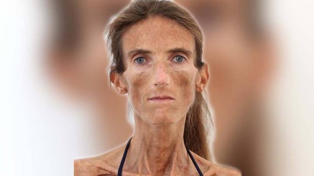 Нейната майка е виновна, че тя тежи само 26 килограма! Вижте как е изглеждала преди!