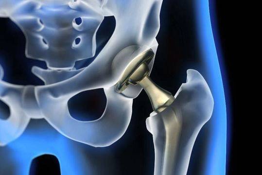 Как да живеем с протеза на тазобедрена става