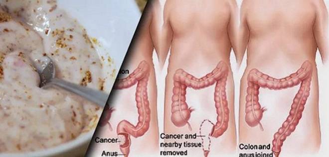 Ето как правилно да пречистите червата си и да махнете до 15кг вредни вещества