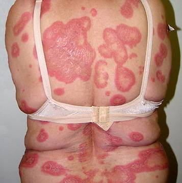 Стрес и Нерви Докарват Псориазис