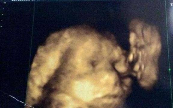 В 9-ия месец от бременността й направили цезарово сечение, но това, което намериха вътре ги остави без думи