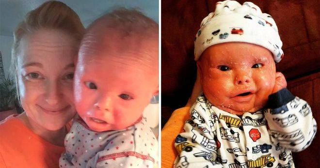 Отчаяна майка къпе сина си с белина и го търка с шкурка, заради много рядка болест (СНИМКИ 18+)