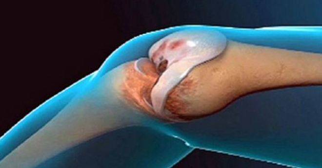 Народен лек остави лекарите безмълвни: Лекува костната тъкан и прави ставите като нови за отрицателно време