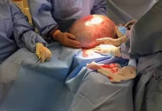 Страховитата история на жена, която отслабваше по съвет на лекар, а след това извадиха 50-килограмово чудовище от нея (СНИМКИ…