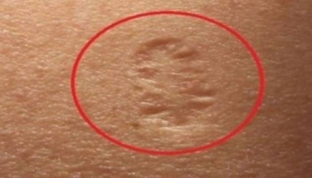 Вижте цялата ИСТИНА за белега на лявото ви рамо!