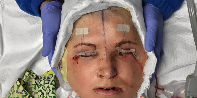 Лекарите присаждат ново лице на 21-годишно момиче, което намира своят нова самоличност