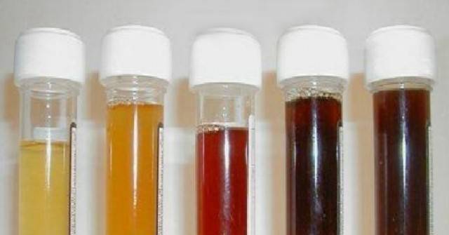 Какъв е цветът на урината: Oт цистит до рак. Важна информация за състоянието на организма