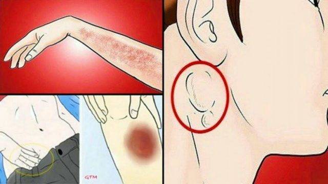 Ако имате подобни мастни образувания по тялото, ЗАДЪЛЖИТЕЛНО трябва да прочетете ТОВА!