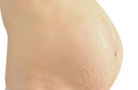 Бяхме на плажа: гледам, няма стрии, а роди наскоро! Откъде пари за лазер? Много просто, не било лазер, а домашно мехлемче: