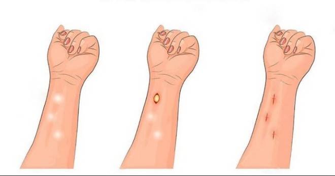 Напълно изчезват за 8 дни: Премахване на мастни натрупвания по тялото