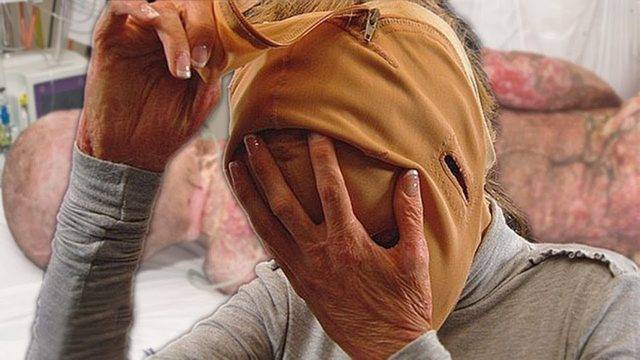 Тази жена свали маската си 2 години, след като беше запалена! Снимките след това ще ви оставят без думи!