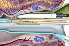 В болница Медлайн в Пловдив, започнахме прилагането на метода за безинцизионно премахване на хемороидалните възли