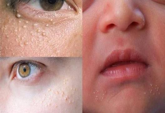 Маха милиумите за броени дни! Кожата става бляскава и без несъвършенства!