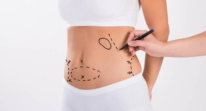 Какво представлява липосукцията?