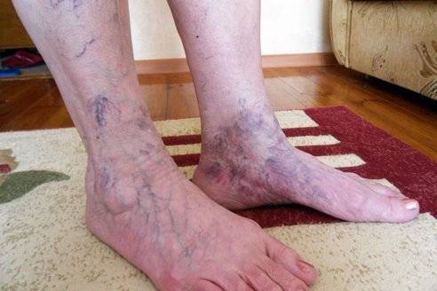 Симптомите на Венозна Тромбоза в Краката