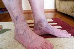 Симптомите на Венозна Тромбоза в Краката