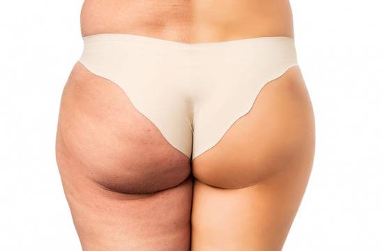 8 Съвета за Премахване на Целулита