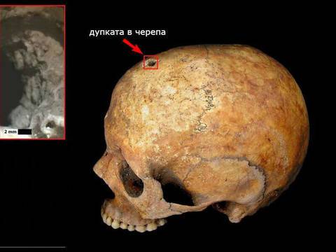 Открито е доказателство за ужасите на медицината от времето на Тъмните векове