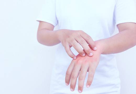 Екзема на ръцете