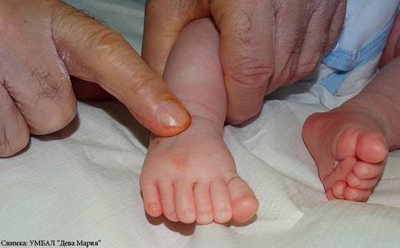 Бебе с шест пръста на всеки крайник оперирано успешно в Бургас