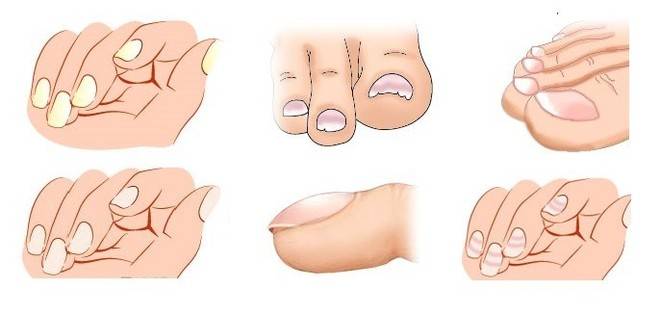 Погледнете ноктите си и разберете кой орган от тялото Ви боледува! (Пълен списък)