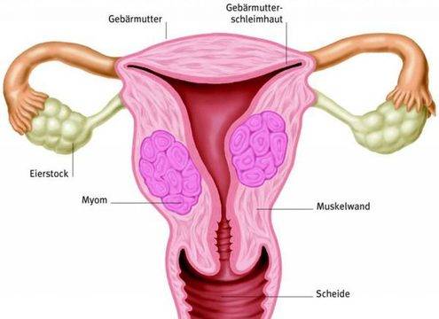 Безплатни прегледи за миома в София