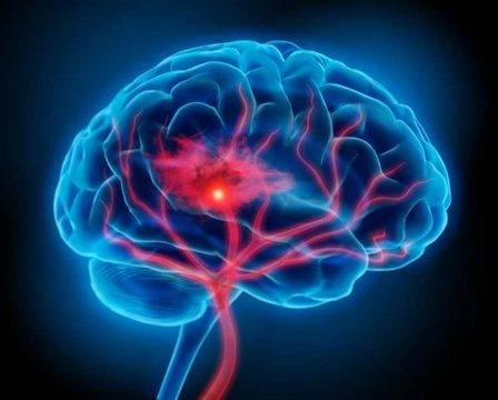 Две лекарства намаляват ефективно риска от повторен инсулт