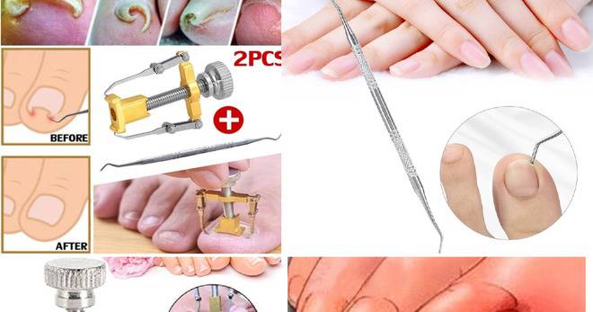 Вродени грижи за краката Козметика за поддръжка на краката Инструмент за корекция на ноктите Клипер за подстригване на SIM…