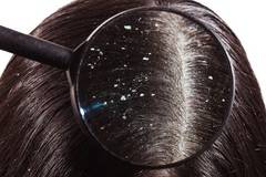 4 природни средства срещу досадния пърхот