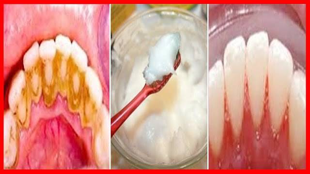 Този Прост Домашен Трик Премахва Зъбния Камък за Минути !