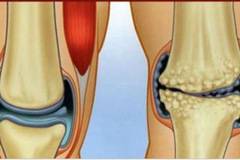 6 Eстествени Противовъзпалителни Средства за Лечение на Болки в Коленете и Ставите!
