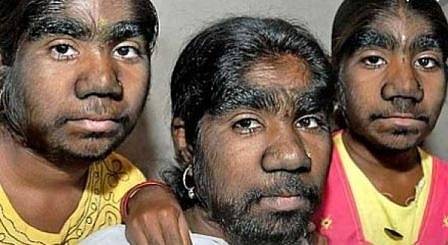 Деца развиха „синдрома на върколака“ заради лекарство