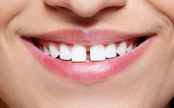 Три решения за премахване на разстоянието между зъбите