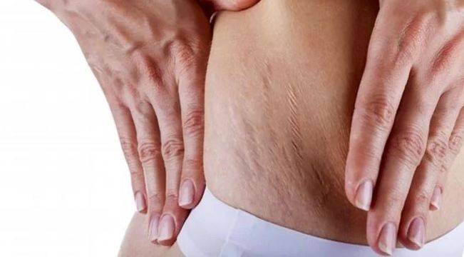 Премахване на Стрии със Сода Бикарбонат